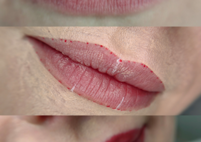 Vorher Nachher Bild von einer Lippenpigmentierung